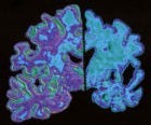 Des chercheurs identifient un mécanisme naturel de défense contre la maladie d'Alzheimer